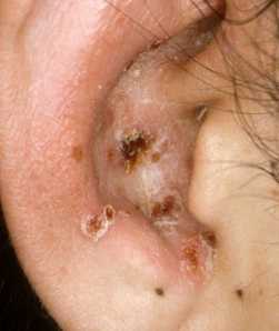 herpes ear